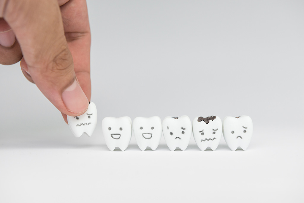 お子さまのむし歯の特徴